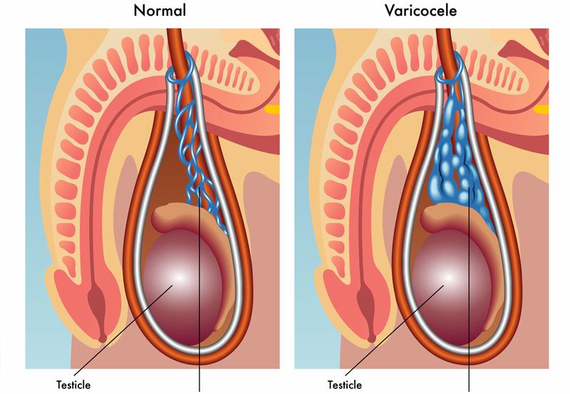 Illustration-of-Varicocele-Dr.-Kai-Wen-Chuang Illustration-of-Varicocele-Dr.-Kai-Wen-Chuang