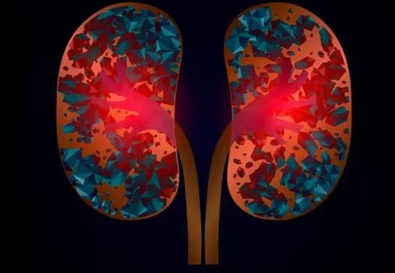 kidney-stones-concept-Dr.-Kai-Wen-Chuan