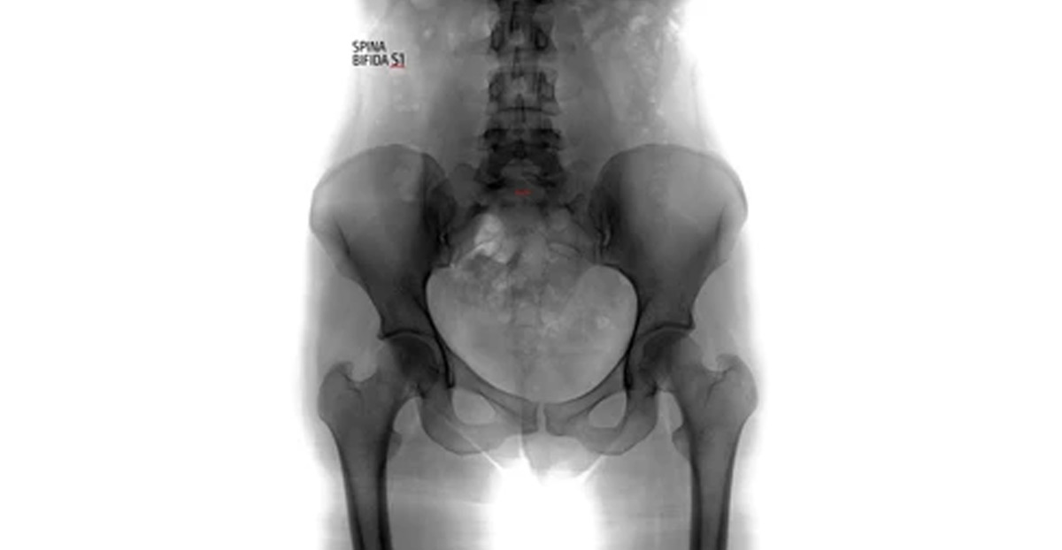 spina-bifida-requiring-urologic-care-Dr.-Kai-Wen-Chuang
