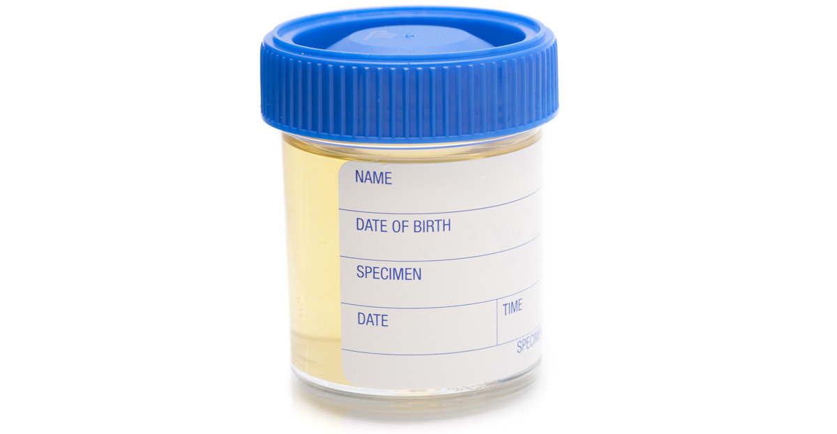 urinalysis-to-test-for-urethral-strictures-Dr.-Kai-Wen-Chuang