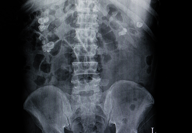 x-ray-showing-kidney-stones-a-symptom-of-ureteropelvic-junction-obstruction-Dr.-Kai-Wen-Chuang