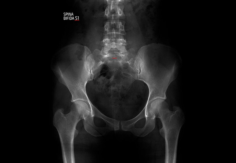 x-ray-showing-spina-bifida-Dr.-Kai-Wen-Chuang x-ray-showing-spina-bifida-Dr.-Kai-Wen-Chuang